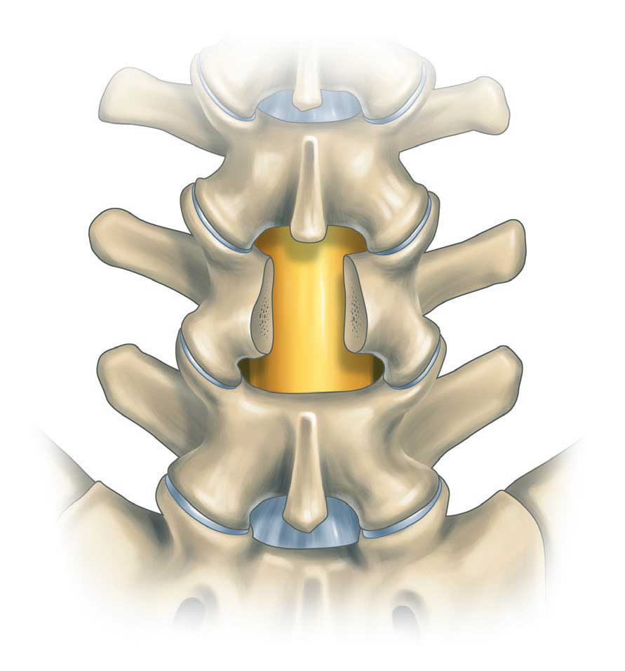 laminectomy