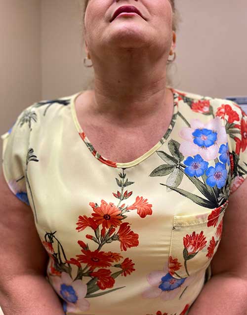 Neck and chin of Mrs. Herrera showing 2 weeks post op and no scar